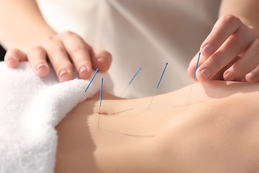 woman undergoing acupuncture
