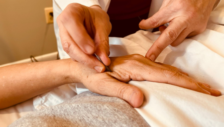 Acupuncture treatment for stress relief at The Teal Center in Arlington Virginia